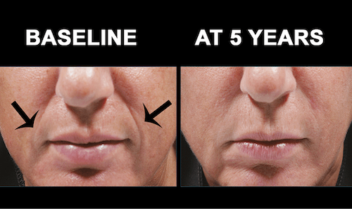bellafill facial volumization before after mississauga oakville